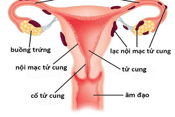 Ngứa âm đạo và đau bụng dưới có thể do lạc nội mạc tử cung