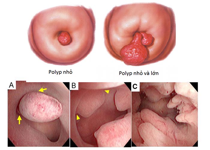 Polyp cổ tử cung không thể tự rụng, cần thực hiện cắt bỏ