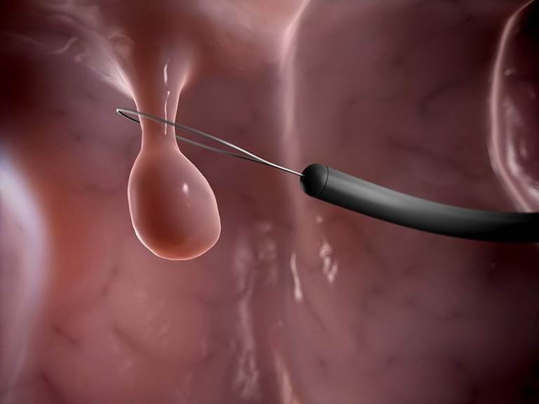 Kỹ thuật cắt polyp cổ tử cung