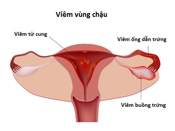 Can thiệp bằng các tiểu phẫu: đặt vòng, nạo hút thai đều là nguyên nhân gây viêm vùng chậu