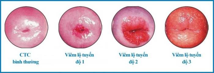 Các cấp độ của viêm lộ tuyến cổ tử cung Viem-lo-tuyen-co-tu-cung