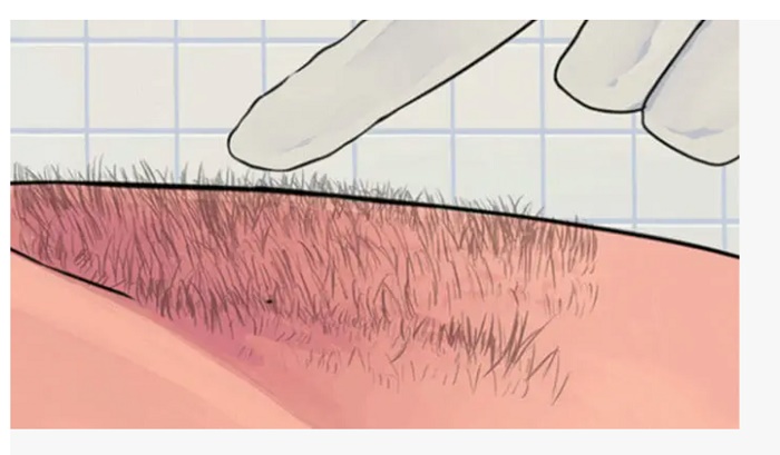 Tỉa lông vùng kίn để dễ dàng chăm sόc và sử dụng dung dịch vệ sinh cho nam