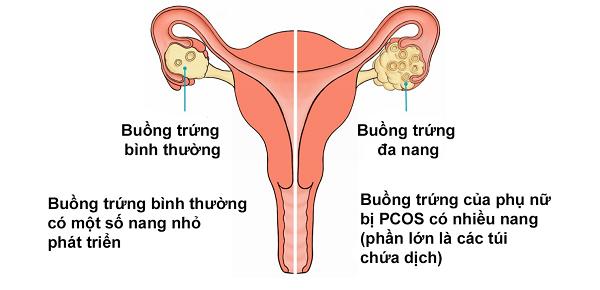 Nguyên nhân gây vô sinh ở nữ giới là do PCOS