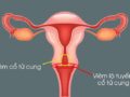 Viêm cổ tử cung và viêm lộ tuyến cổ tử cung có phải là cùng một bệnh?