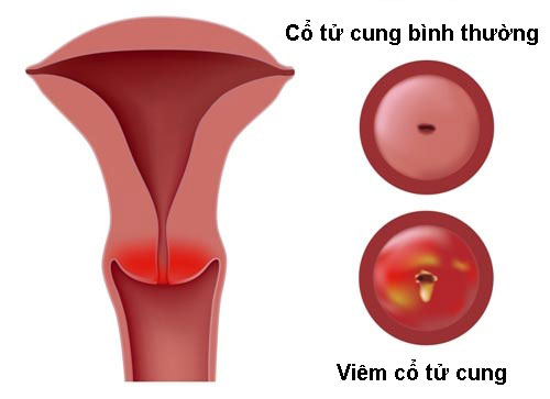Viêm cổ tử cung là bệnh lý phụ khoa phổ biến nhiều nữ giới gặp phải
