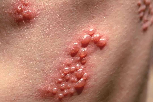                                                          Tổn thương do các herpes virus gây ra                               Tổn thương do các herpes virus gây ra