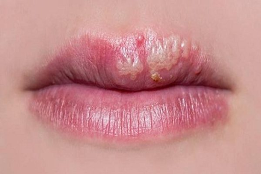                                                          Vết loét xuất hiện trên vành môi                                               Vết loét xuất hiện trên vành môi                                     Vết loét xuất hiện trên vành môi