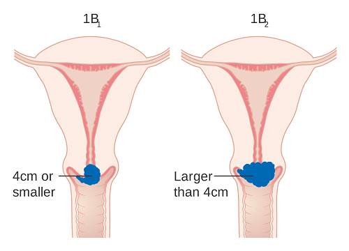 hình ảnh ung thư cổ tử cung giai đoạn đầu 