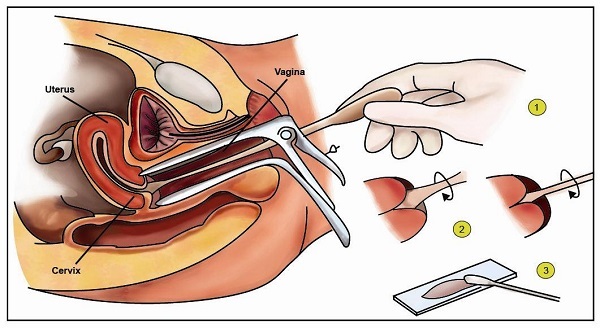 Hình ảnh phẫu thuật cắt bỏ khối u K cổ tử cung