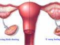 U nang buồng trứng: Nguyên nhân và dấu hiệu nhận biết bệnh