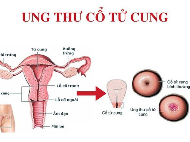 Hình ảnh siêu âm ung thư cổ tử cung